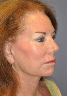 Facelift and Neck Lift 3093