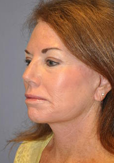 Facelift and Neck Lift 3093