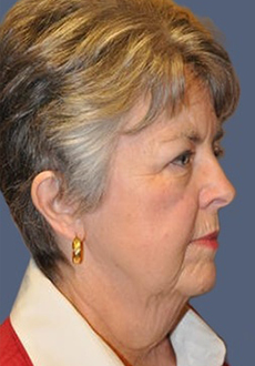 Facelift and Neck Lift 3107
