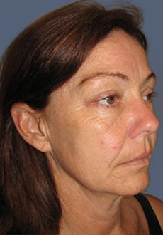Facelift and Neck Lift 3135
