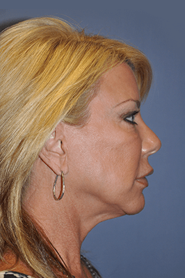 Facelift and Neck Lift 3602