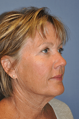 Facelift and Neck Lift 3368