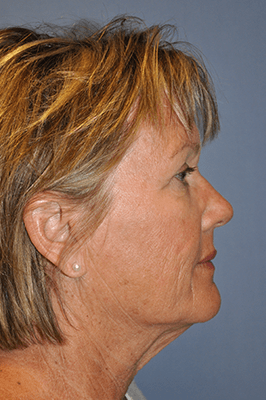 Facelift and Neck Lift 3368