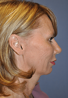 Facelift and Neck Lift 3019