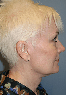 Facelift and Neck Lift 3751