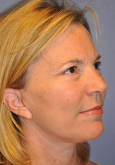 Facelift and Neck Lift 3114