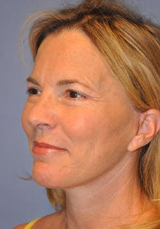 Facelift and Neck Lift 3114