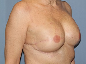 Breast Reconstruction 3340
