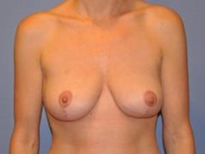 Breast Lift 2700