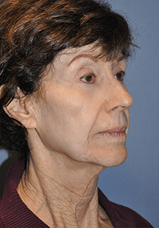 Facelift and Neck Lift 3457