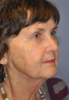 Facelift and Neck Lift 3086