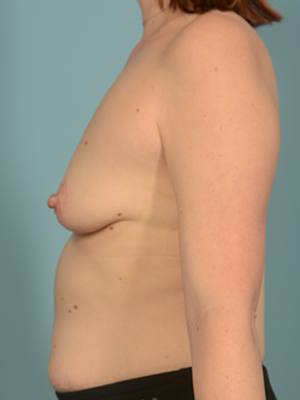 Breast Augmentation 23126