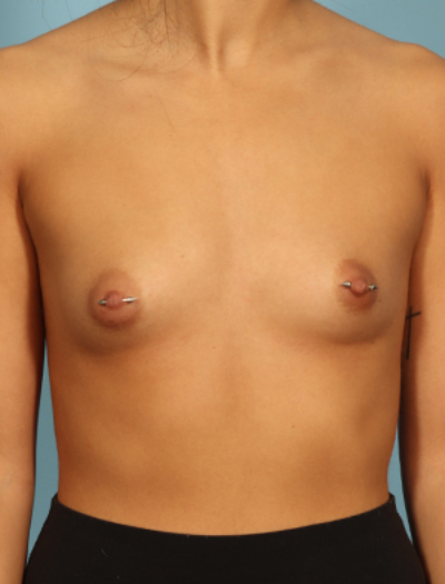 Breast Augmentation 29411