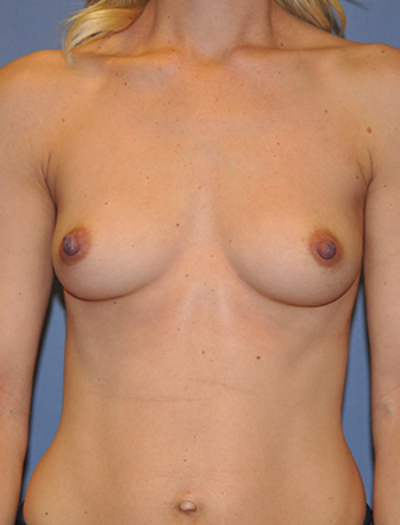 Breast Augmentation 13290