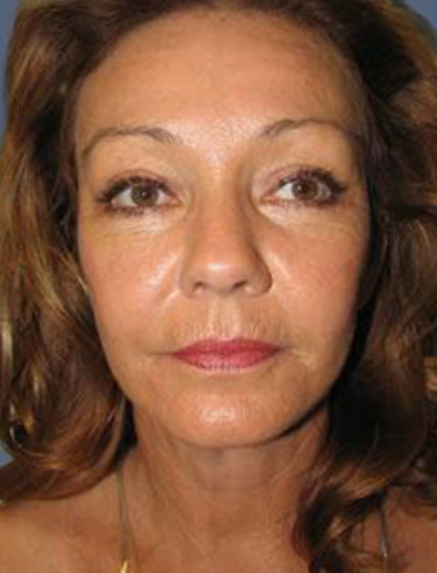 Facelift and Neck Lift 3135
