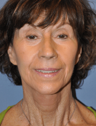 Facelift and Neck Lift 3457
