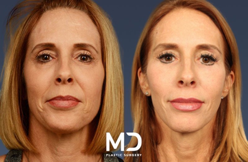 Mid Facelift 3 Combined Image