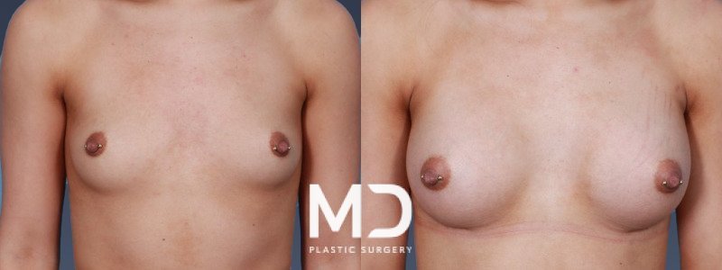 Breast Augmention 9 Combined Image