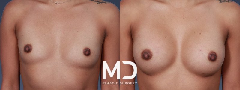 Breast Augmentation 8 Combined Image